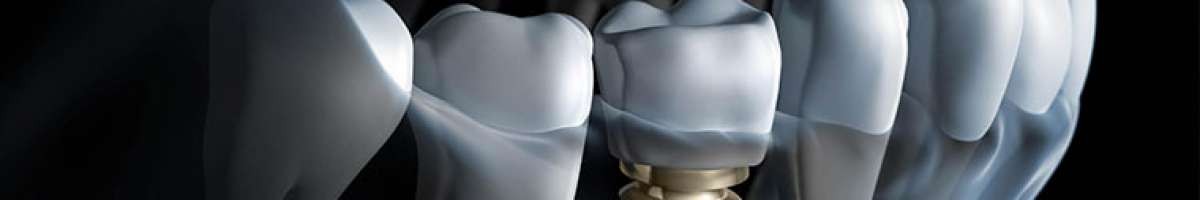 DENTAL IMPLANTS & PERIODONTAL HEALTH 