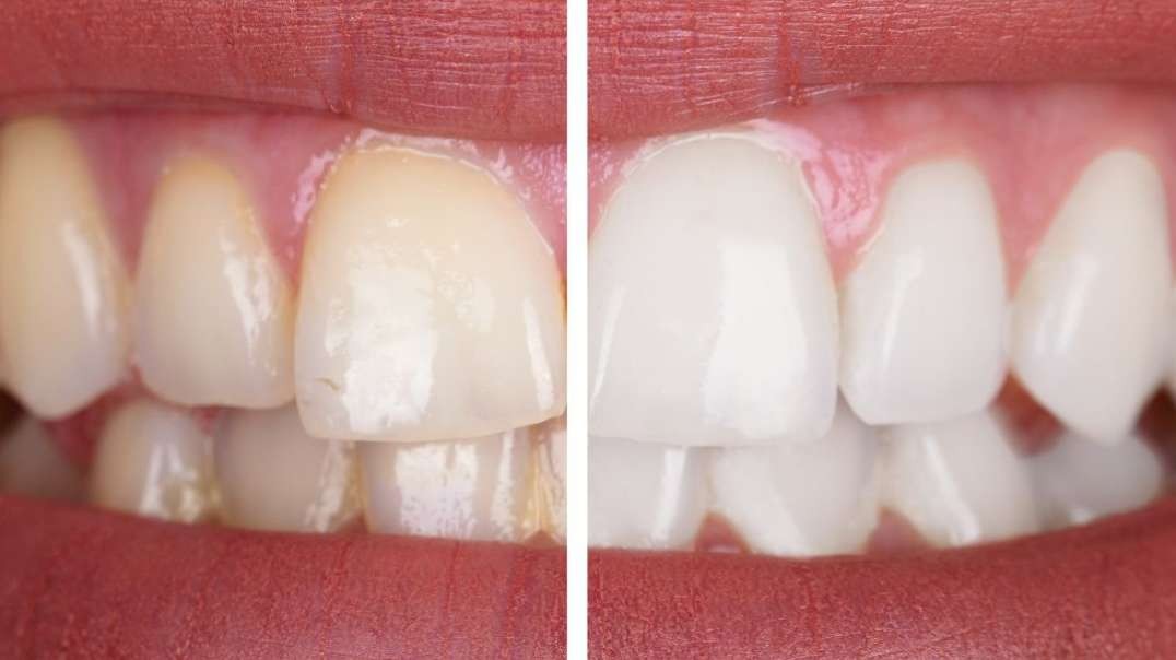 Teeth Whitening in Miami Springs, FL : Apple Dental Group