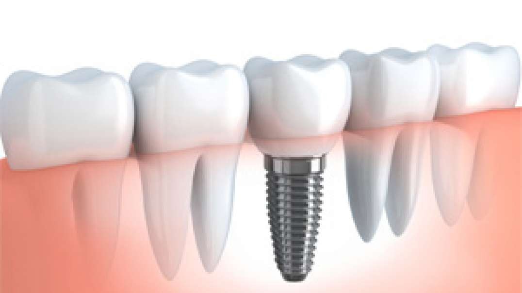 Dr. Juan F. Quintero, DMD : Dental Implants in Palmetto Bay, FL