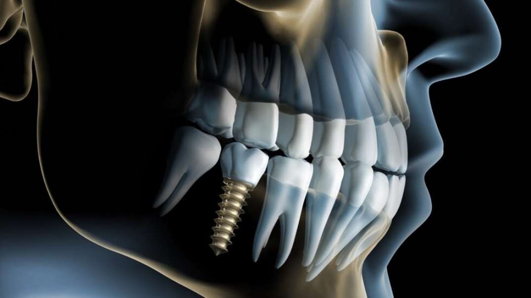 Advanced Dental Solutions : #1 Dental Implant in Sunset, FL