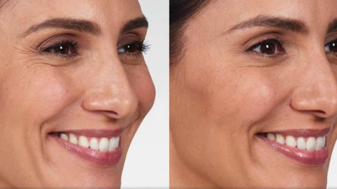 Advanced Dental Solutions : Botox in Sunset, FL